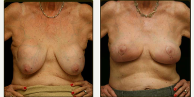 78 year old woman treated with Breast Implant Removal and Wise Pattern Lift - This patient is 78 years old. She came to Dr. E wanting to remove her saline implants that were over 30 years old. Dr. E preformed a capsulectomy implant removal and a wise pattern lift.