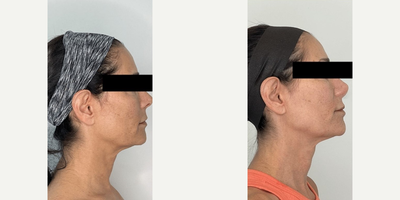 Woman treated with Morpheus8, Lumecca - See the incredible results of 2 Lumecca sessions & Morpheus8.