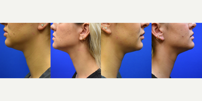 25-34 year old woman treated with Evolve - This patient treated with Evoke non-invasive facial contouring of the jawline and under chin fat pad. A total of 4 treatments.