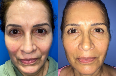 Woman treated with Mini Facelift - How amazing is this before and after mini face lift? Her face is now more contoured with a firmer appearance and a rejuvenated look!