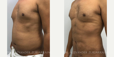Man treated with Vaser Liposuction - Man treated with Vaser Liposuction
