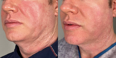57 year old male treated with Ellacor - This male patient had Ellacor performed on his neck and a drastic improvement in skin sagging was the result.