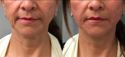 Middle-Aged Woman with NovaThreads - This is before and immediately after a NovaThreads procedure. This is a non-surgical way to lift sagging areas like the jowls and stimulate collagen production.