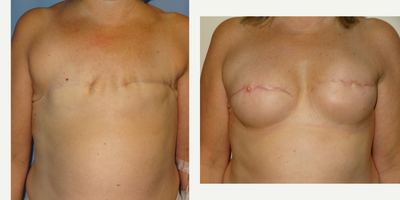 45-54 year old woman treated with Breast Reconstruction - Bilateral breast and nipple reconstruction. Implants used for breasts. Tattooing pending.