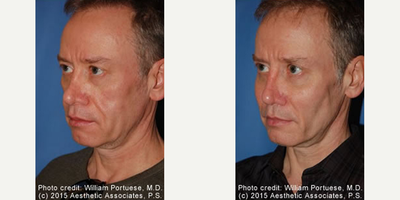 Man treated with Cheek Implants - Man treated with Cheek Implants