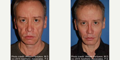 Man treated with Cheek Implants - Man treated with Cheek Implants