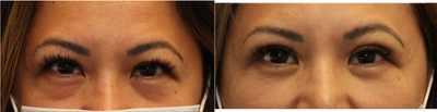Upper and lower blepharoplasty surgery - Upper eyelid skin folds were lifted (double eyelid) and lower eyelid bags repositioned