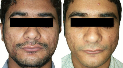Venus Viva - Before and After 8 Treatments. &nbsp;Photos provided courtesy of Venus Concept, performed by Megha Joy Shah, MD.
