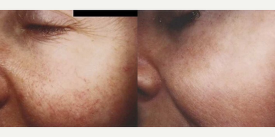Woman treated with Pulsed Dye Laser - Woman treated with Pulsed Dye Laser