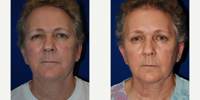 Woman treated with Brow Lift - Woman treated with Brow Lift