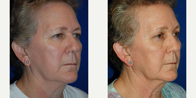 Woman treated with Brow Lift - Woman treated with Brow Lift