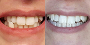 Straighten your teeth without braces - Photo provided courtesy of SmileDirectClub.
