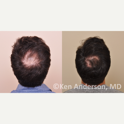 25-34 year old man treated with PRP for Hair Loss - 29 year old male, 11 months after his visit with us.