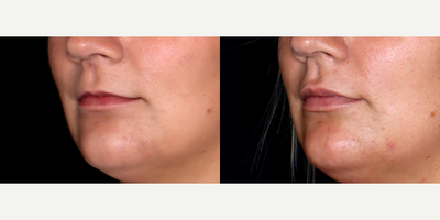 24year old woman treated with Volbella - 24 year old woman treated with Volbella, Lip Fillers. Photos depict before and 1 month after treatment.