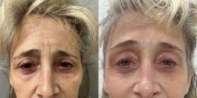 55-64 year old woman treated with Brow Lift - 64 y/o woman underwent brow lift under sedation in our office O.R.