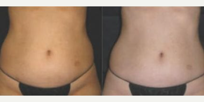 Woman treated with Velashape - Woman treated with Velashape