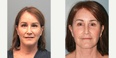 54 year old woman treated with Lifestyle Lift - This 54 year old patient underwent a LiteLift, along with a platysmaplasty. Through a hairline incision hidden within the ear, under local anesthesia, he reduced the signs of aging around the jaw, neck, and lower face.