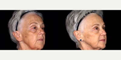 72 year old woman treated with 3 syringes of Bellafill to cheeks and under eye - 72 year old woman treated with 3 syringes of Bellafill to cheeks and under eye. Photos depict before and 3 months after treatment.