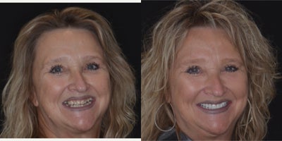 55-64 year old woman treated with Dental Bridge, Porcelain Veneers - Zirconia Bridges and Porcelain VeneersThis patient underwent a transformative smile makeover with a combination of Zirconia bridges and porcelain veneers. Zirconia bridges were used to replace missing teeth, ensuring exceptional durability, strength, and a natural look. Porcelain veneers were crafted to enhance the shape, color, and alignment of the remaining teeth, providing a bright and harmonious smile. Together, these treatments deliver both aesthetic beauty and functional improvement, tailored to the patientsneeds.