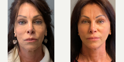 55-64 year old woman treated with Deep Plane Facelift, Facial Fat Transfer, Renuvion - Patient had a deep plane facelift with Renuvion for added skin tightening combined with facial fat grafting to restore natural anatomy.