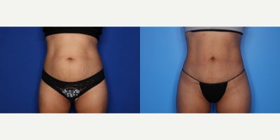 35-44 year old woman treated with BodyTite, Liposuction, Tumescent Liposuction - 41 year old female shown 3 months after BT lipo 360 (abdomen/flanks). She had 1.9 L removed.