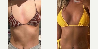 25-34 year old woman treated with Breast Lift, Breast Implants - Breast augmentation performed to enhance volume and improve proportion.