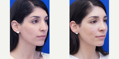 25-34 year old woman treated with Rhinoplasty - Nasal bridge bump and C-shape deformity are corrected via the endonasal route with minimal dissection and operation of the nasal tip except for mild rotation.  The result of a more dainty nose is observed.