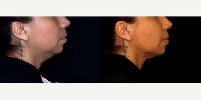 41 year old woman treated with Liposuction, PrecisionTx - 41 year old female treated with submental liposuction (Precision tx) Photos depict before and 6 months after surgery