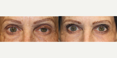 Enigmalift - Eyelid ptosis repair to improve eyelid symmetry with laser resurfacing.