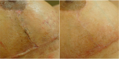 Breast lift scar before and after treatment with embrace - Photo provided courtesy of Neodyne Biosciences, Inc.
