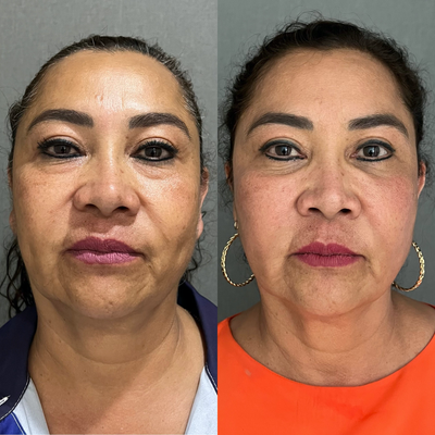 45-54 year old woman treated with Morpheus8 - MORPHEUS 8 BURST FACE AND NECK