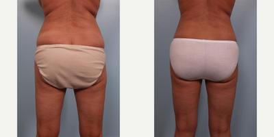 45-54 year old woman treated with Mommy Makeover - Age: 45. This woman came to my practice because she had multiple concerns. Her large breasts were causing back and shoulder pain. She wanted to improve the appearance of her abdominal area including the large abdominal scar from a non-elective surgery performed by another surgeon. She also wanted to reshape her flanks and thighs. I performed a Mommy Makeover that included breast reduction with a vertical incision; a complete tummy tuck to tighten her abdominal muscles, remove the old surgical scar, and reshape her belly button; and liposuction of the bra fat, flanks, and both the inner and outer thighs.