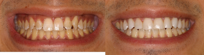 DURAthin minimal preparation porcelain veneers - Male, aged 29.&nbsp; Patient had already done Invisalign to straighten his teeth but was still unhappy with the spacing along the edges of his upper teeth as well as the rotation on his eye teeth.&nbsp; We placed DURAthin porcelain&nbsp;veneers&nbsp;(like Lumineers) which are minimal preparation or no-preparation&nbsp;porcelain veneers on his upper 8 teeth.&nbsp; Because of the shape of his teeth, there was no other option to close the spaces along the edges of the teeth.&nbsp; Results like this can be achieved in as little as 2 appointments, just 2-3 weeks apart!&nbsp;