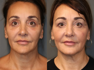 Pan Facial Rejuvenation - Upper and lower lid filler, temple and jawline rejuvenation.