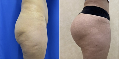 Butt Augmentation - Woman treated with Butt Augmentation