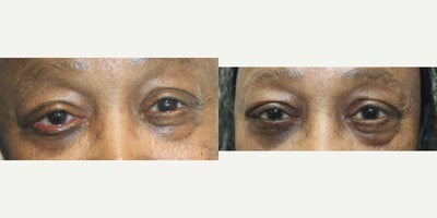 45-54 year old woman treated with Eyelid Surgery, Eyelid Retraction Repair - Ectropion Repair of the right Lower Eyelid