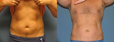 Exilis body - 
	This man had his abdomen tightened with Exilis and fat reduction
