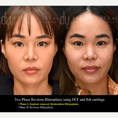 35-44 year old woman treated with Rhinoplasty, Asian Rhinoplasty, Revision Rhinoplasty, Septoplasty, Alarplasty - Revision Rhinoplasty with her own rib cartilage and DCF. This revision had to be done in 2 phases due to the poor quality of her skin from previous silicon implant. Phase I: Silicone implant removal Phase II: Revision Rhinoplasty with rib cartilage and DCF