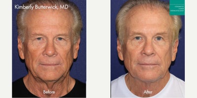 ThermiSculpt, Fraxel and IPL by Dr. Butterwick - ThermiSculpt, Fraxel and IPL by Dr. Butterwick