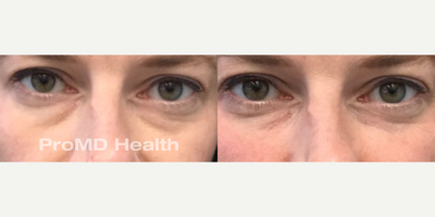 Woman treated with Dermal Fillers, Hyaluronidase, Sculptra - Woman treated with Dermal Fillers, Hyaluronidase, Sculptra