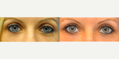 25-34 year old woman treated with Restylane Silk - 32-year-old female, one syringe of Restylane Silk under the eyelid for rejuvenation. 2 weeks post op.