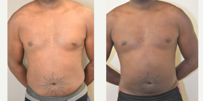 40 year old man treated with Tumescent Liposuction - SAFE lipo technique abdomen and flanks