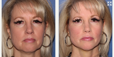 55-64 year old woman treated with Silhouette InstaLift - Instalift