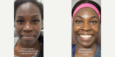 Woman treated with Moxi - Woman treated with Moxi