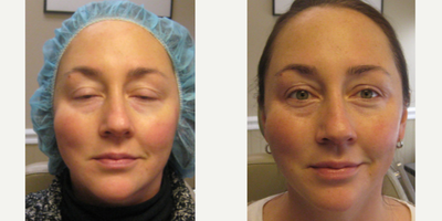 45-54 year old woman treated with ResurFX - 57 year old female underwent ResurFx sessions.