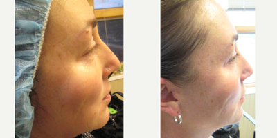 45-54 year old woman treated with ResurFX - 57 year old female underwent ResurFx sessions.