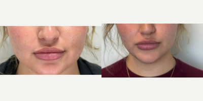 25-34 year old woman treated with Botox, Botox for Migraines, Lip Fillers - TMJ Botox and Lip filler correction. Treated by Aubrey Houchin, R.N.