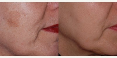 45-54 year old woman treated with Laser Resurfacing - 45-54 year old woman treated with Laser Resurfacing