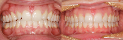 38 Year Old Female Braces - Patient was concerned with smile esthetics.  She wanted her smile to be wider and brighter.  Traditional braces were used for 10 months on the top and bottom teeth.