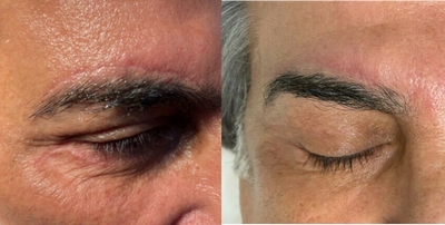 65-74 year old man treated with Eyebrow Scar Removal - Mixto fractional Co2 laser resurfacing and fillers were used to remove indented and unsightly scars from a direct brow lift surgery. Several sessions over 3 months were needed. Each time the skin heals over 5-7 days and the scars look about 20-30% better.